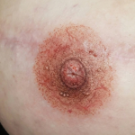 ¿Cuándo hacer la micropigmentación de areolas? Tiempos, cuidados y seguridad