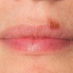 ¿Te da miedo hacerte la micropigmentación de labios por el herpes?